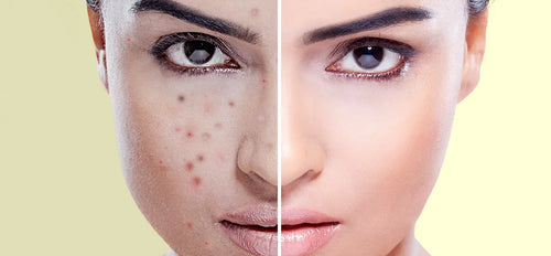 Say Goodbye to Pesky Acne with Ackn Go Gel